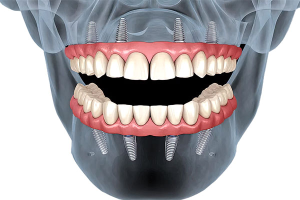 All-on-4-dental-implants-top-and-bottom
