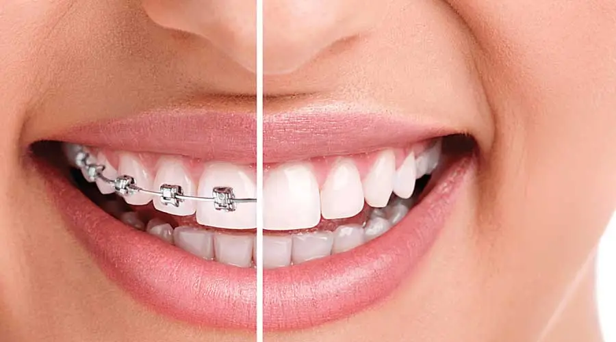 Braces-1