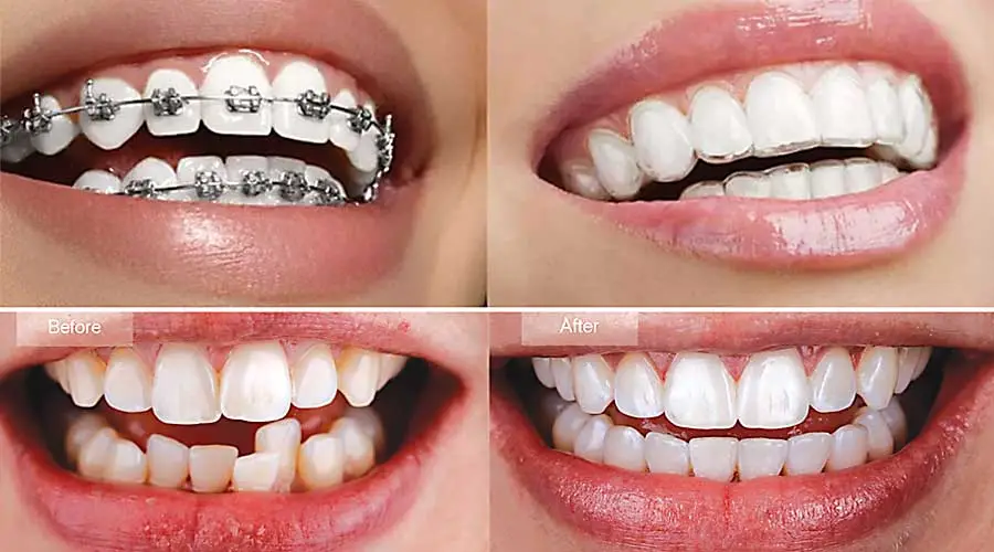 Braces-before-and-after-with-clear-braces