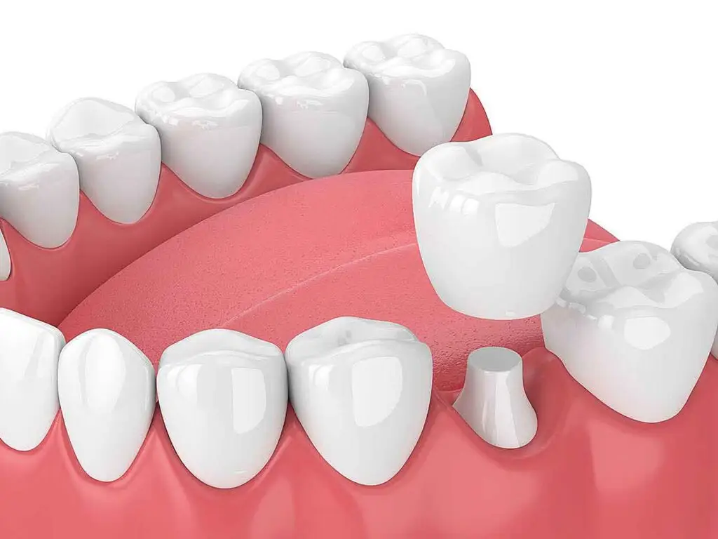 Dental-crown