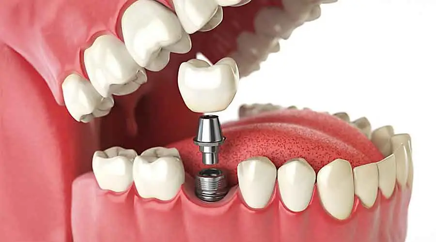Implants-1