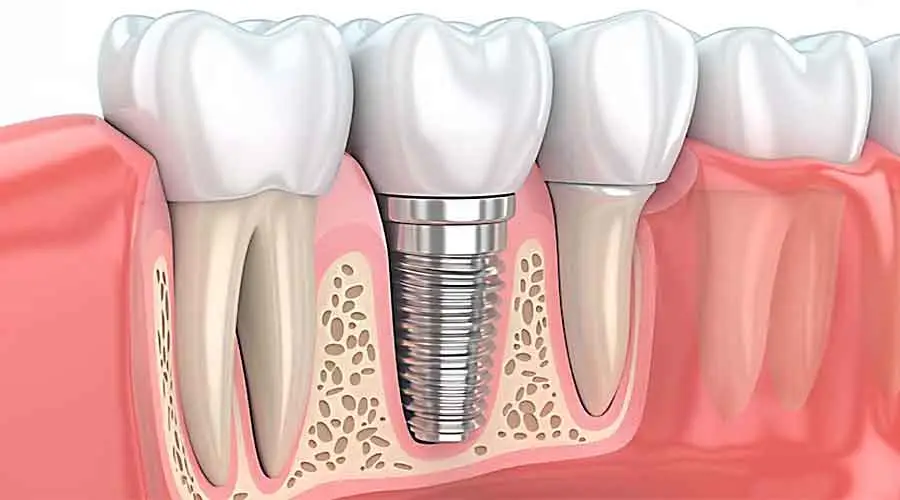 Implants2