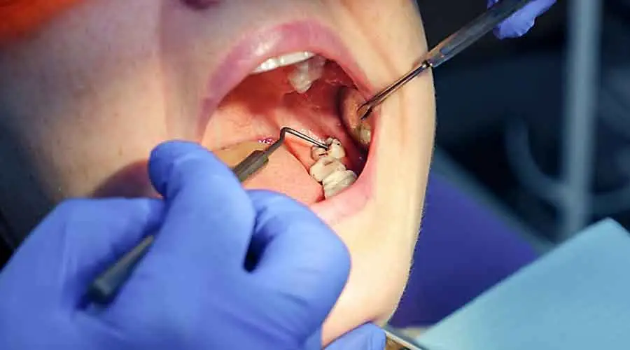Tooth-extraction-2