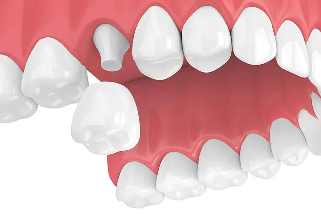 dental-crown-2