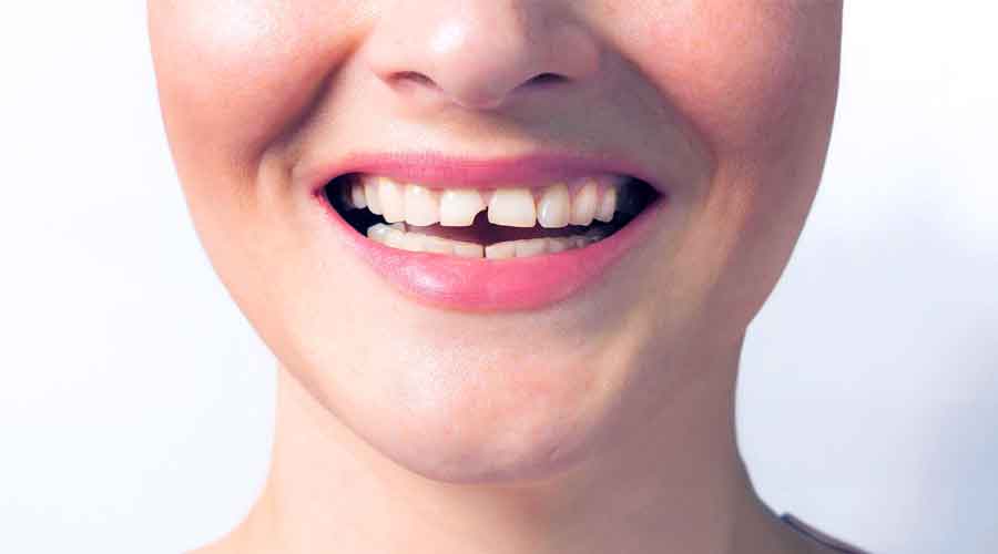 Broken-tooth-1