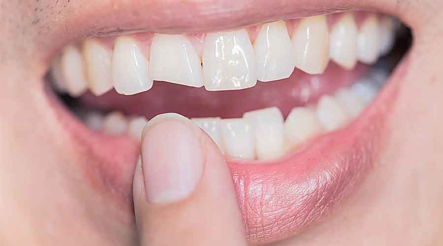 Broken-tooth-2