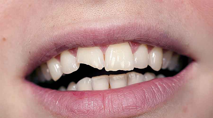 Broken-tooth-3